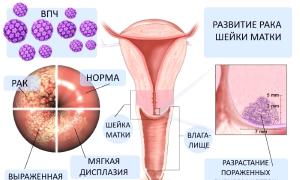 Cancer de col uterin: un rezultat favorabil este cancerul de col uterin real